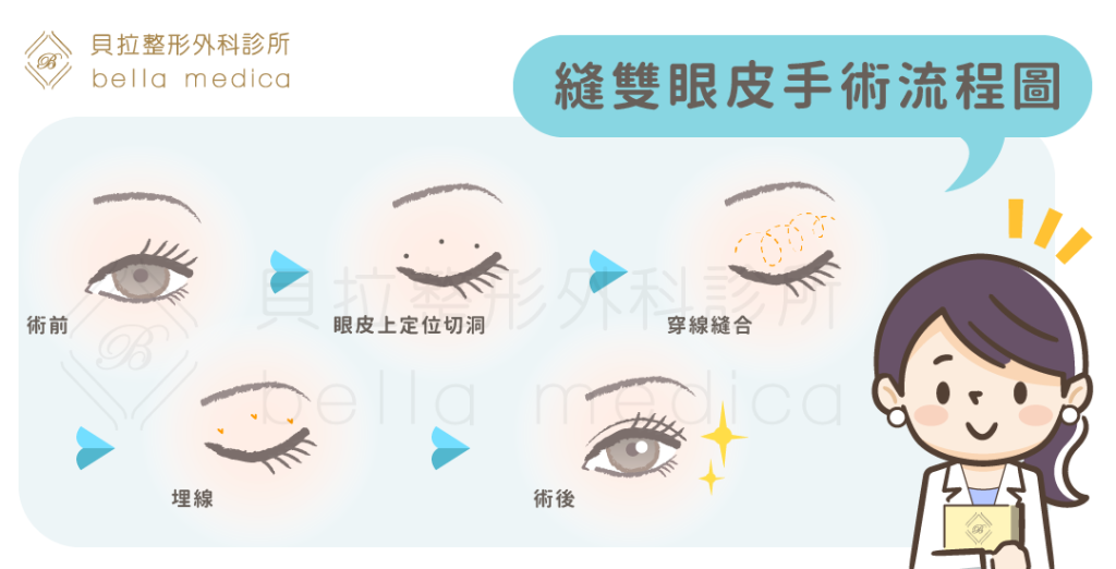 縫雙眼皮